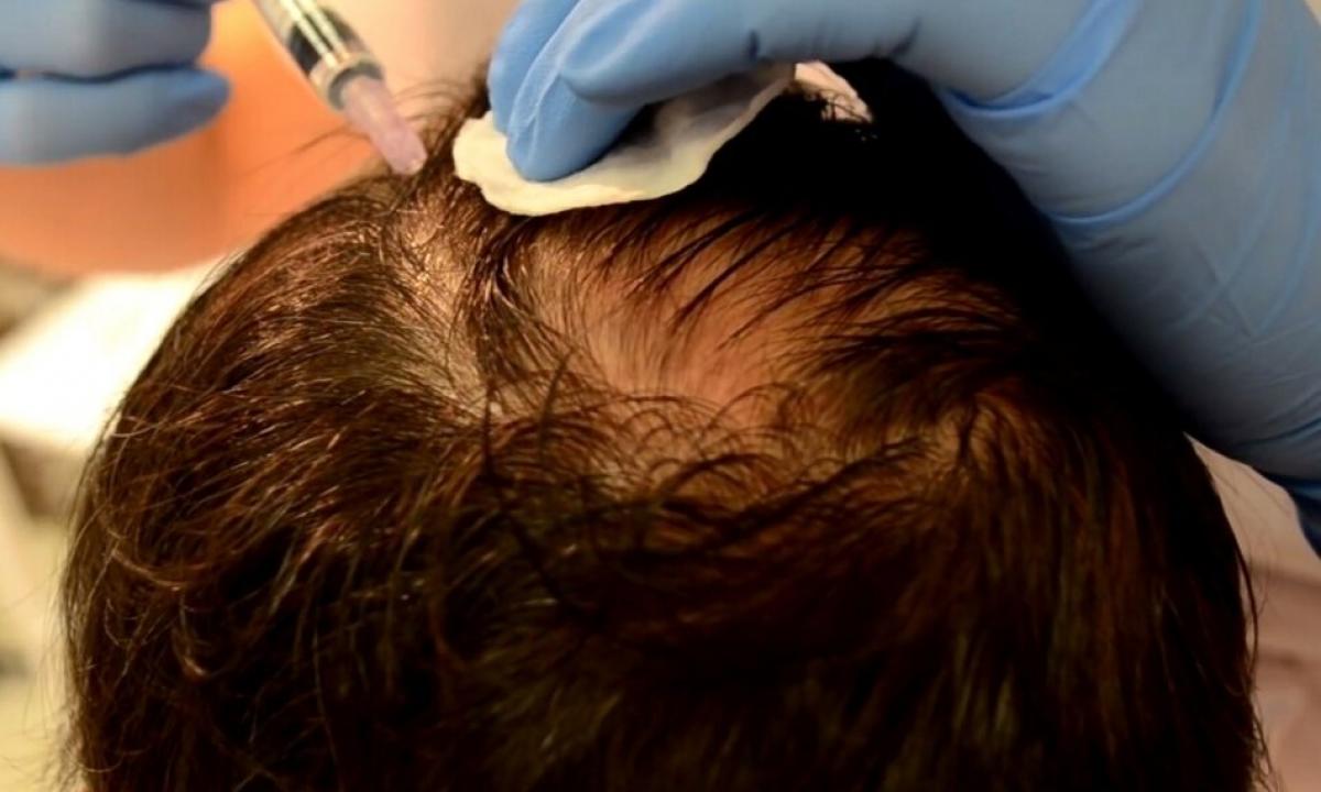 Mesotherapy — rescue or loss of hair?