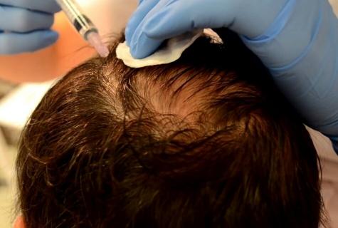 Mesotherapy — rescue or loss of hair?
