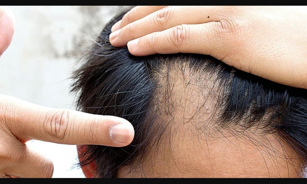 How to restore growth of hair