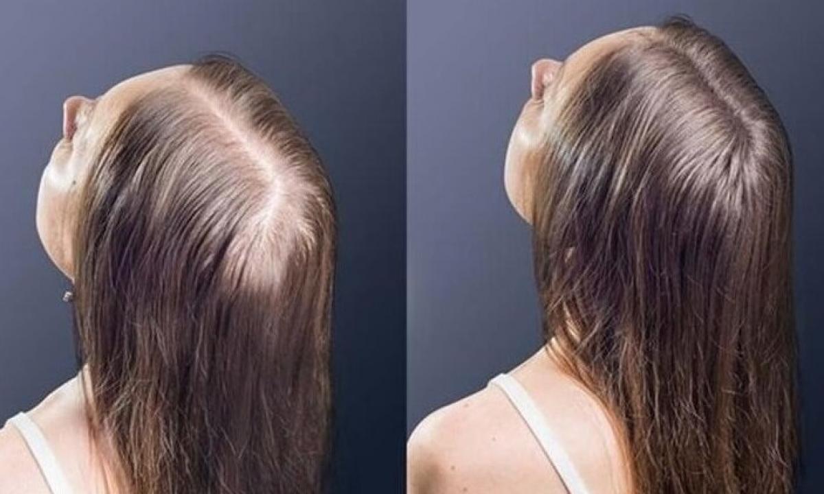 Выпадение волос у женщин до и после