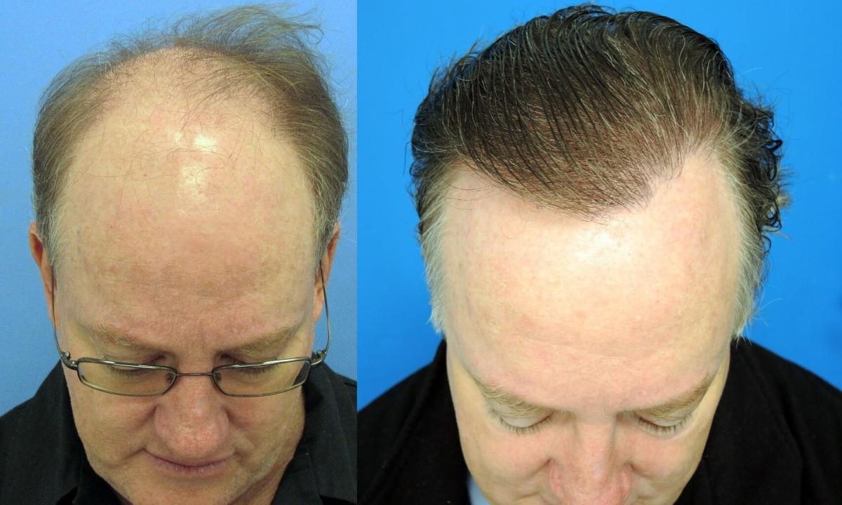 Natural means against hair loss