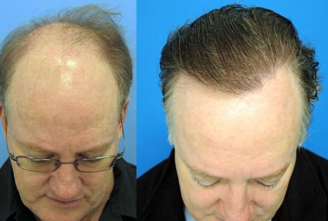 Natural means against hair loss