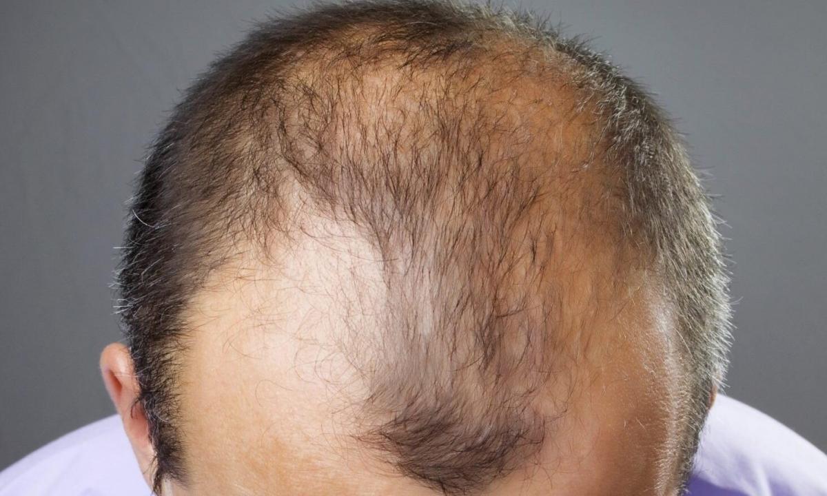 Grass broths from hair loss