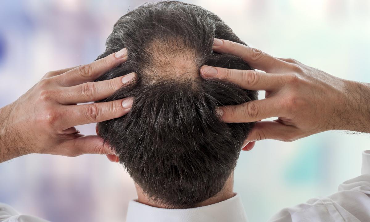 How to choose hair loss medicine for men