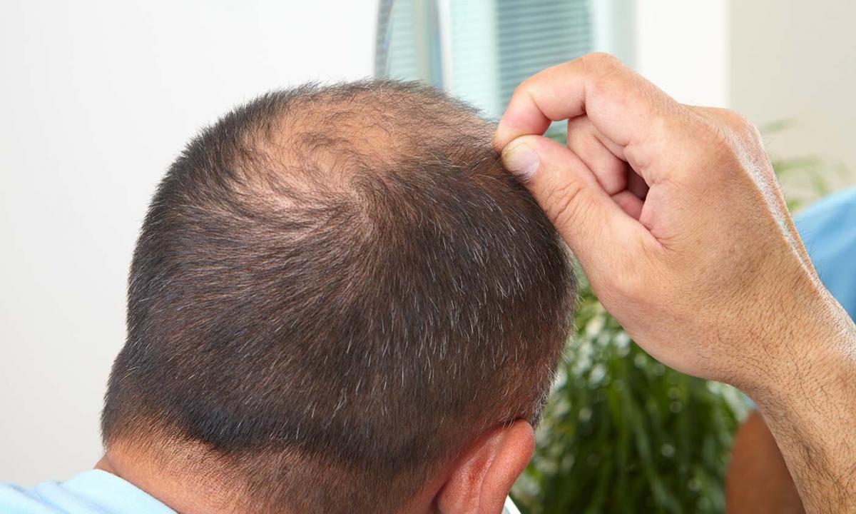 How to cope with hair loss
