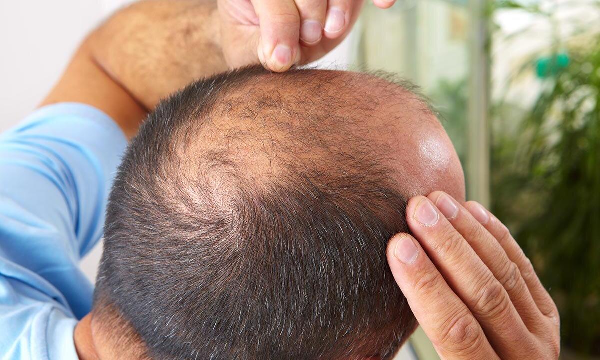 How to prevent baldness