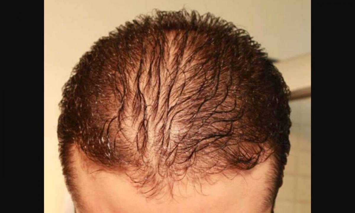 What daily norm of hair loss