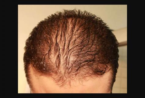 What daily norm of hair loss