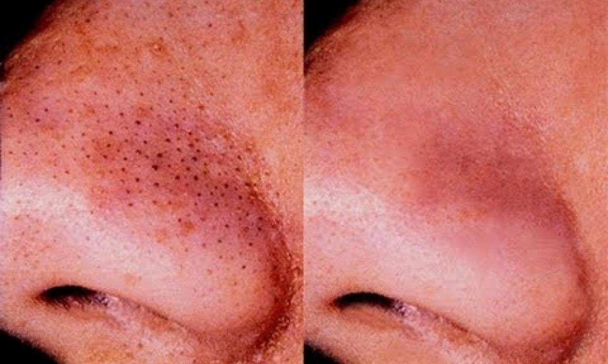 How to get rid of black dots and enlarged pores
