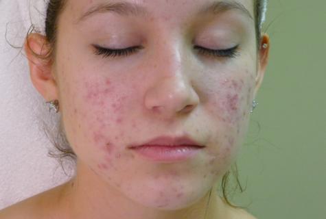 How to cure acne rash
