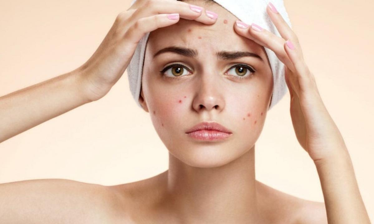 How to get rid of pimples and imperfections of face skin