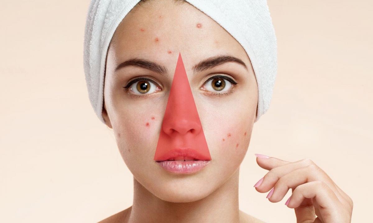 How to choose means for fight against pimples