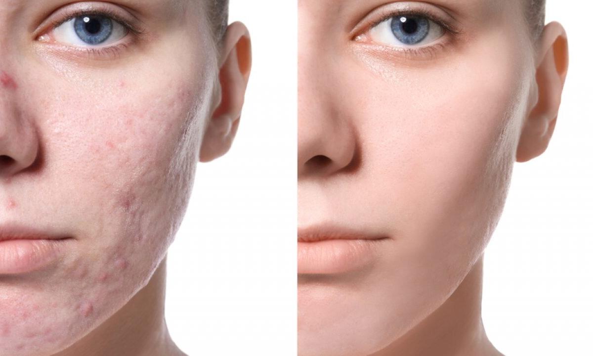 Skin clarification by make-shifts