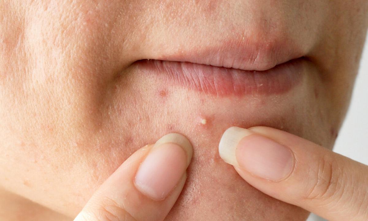 How to press pimples not painfully