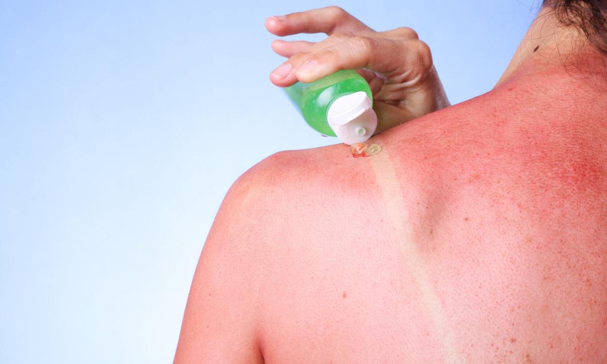 How to get rid of solar burns