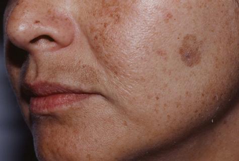 How to get rid of senile spots