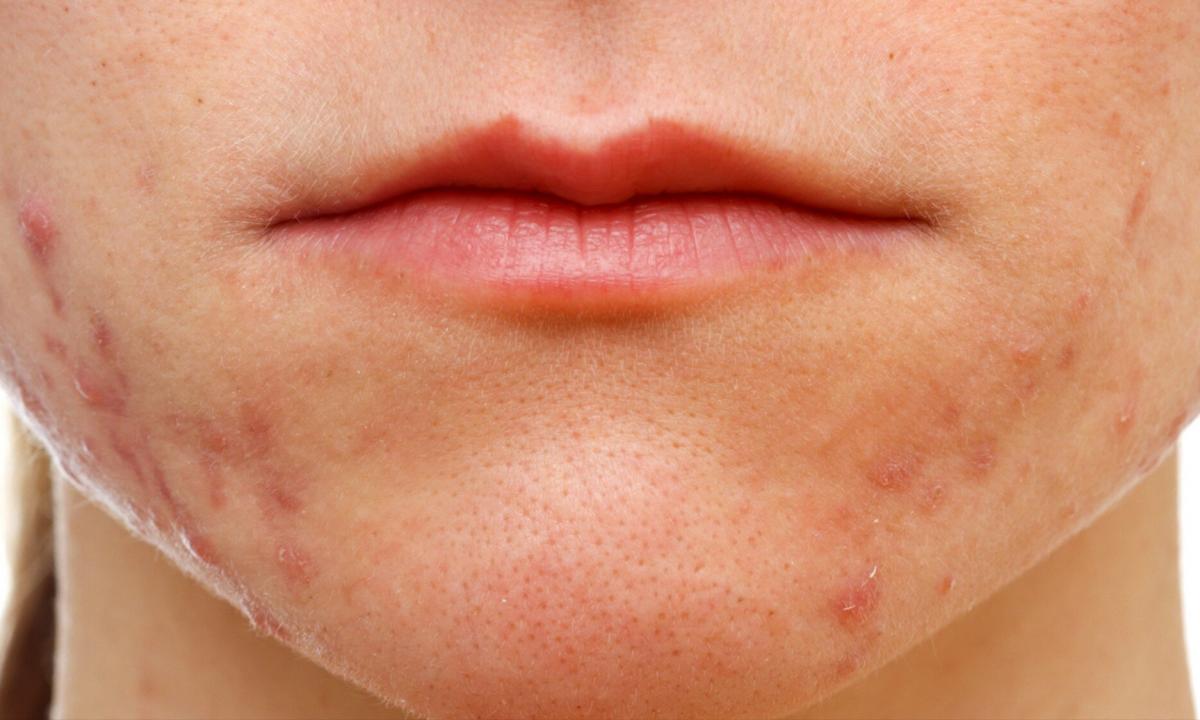 What best acne rash medicine