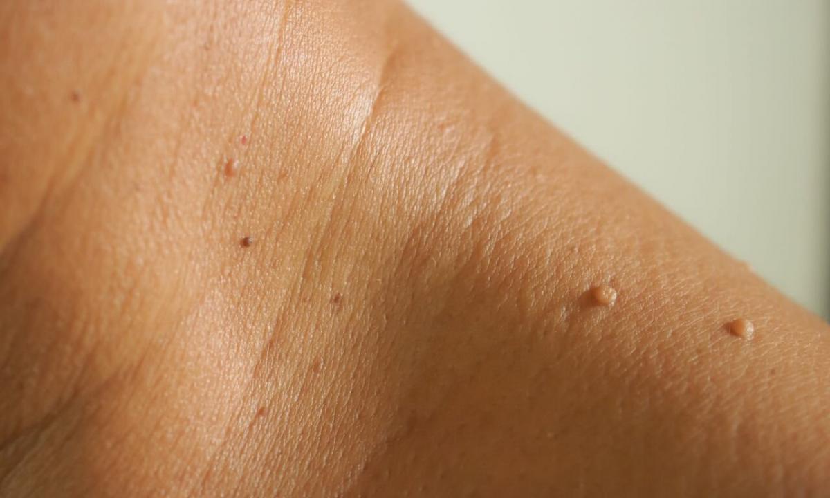 How to remove flat warts