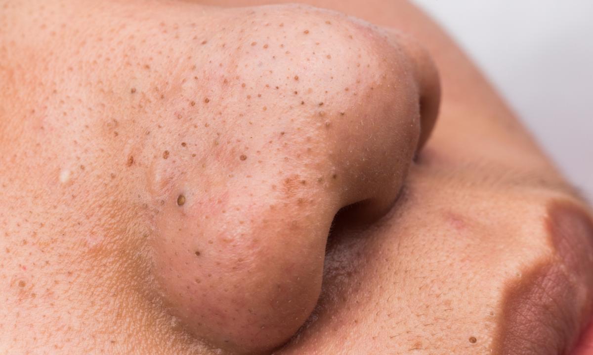 How to get rid of black dots on face and body