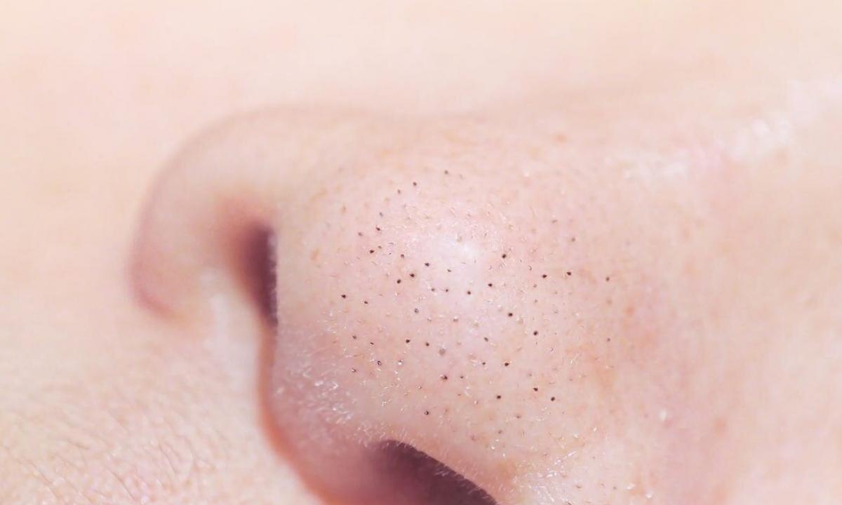 How to remove black dots on nose