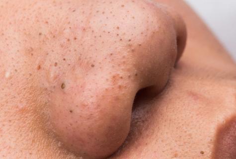How to get rid quickly of pimples and black dots