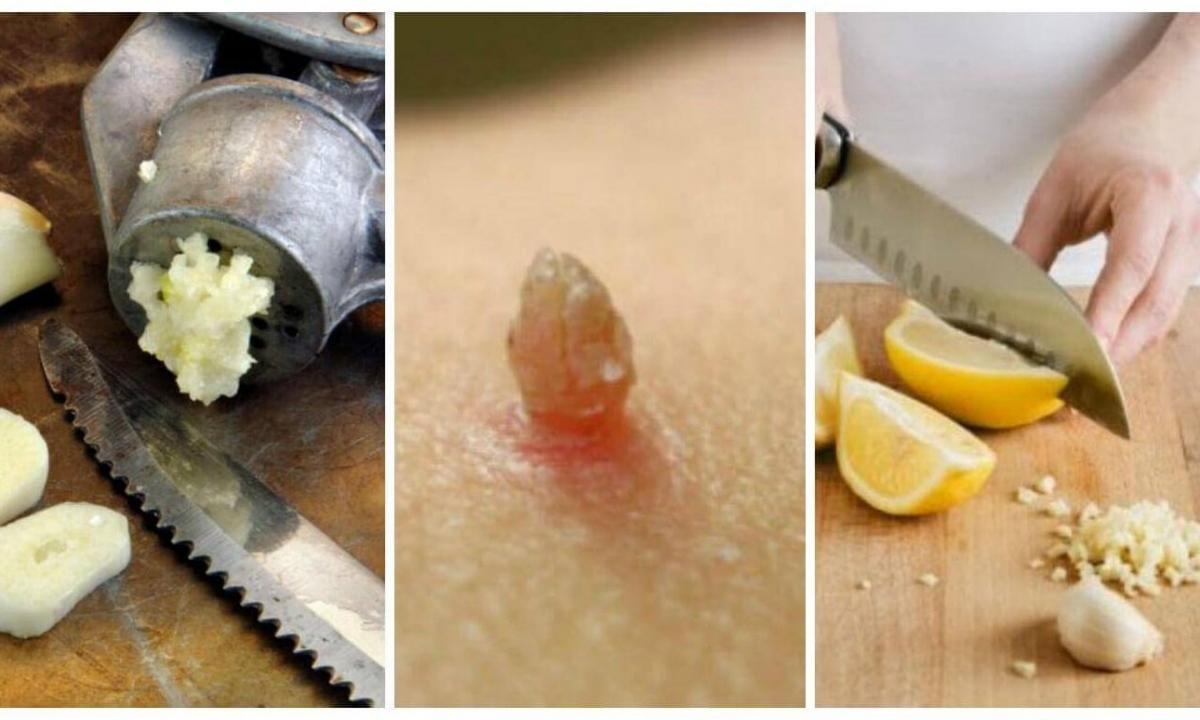 How quickly to get rid of wart folk remedies