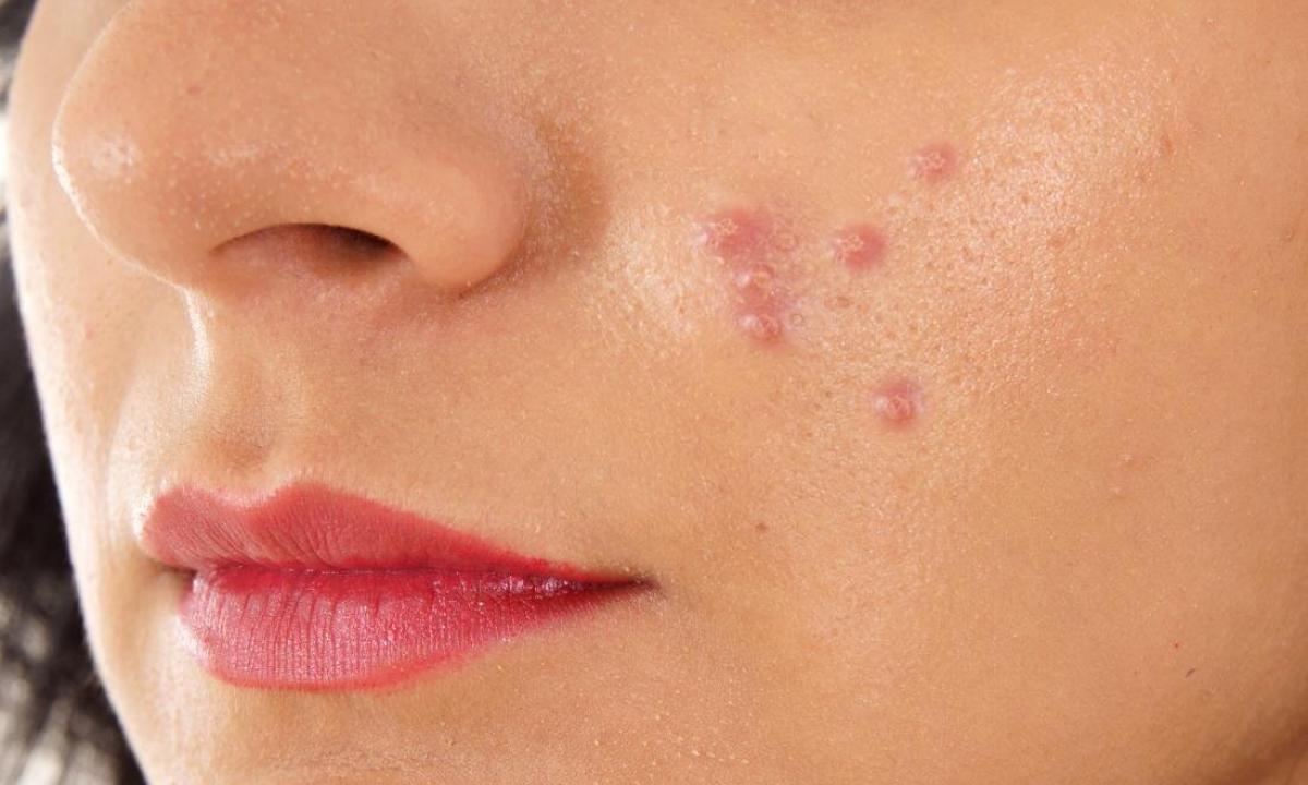 As on face to remove hems from pimples