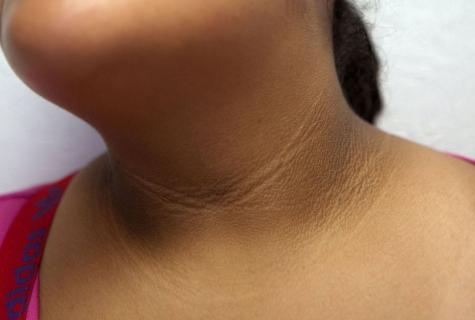 How to get rid of folds on neck