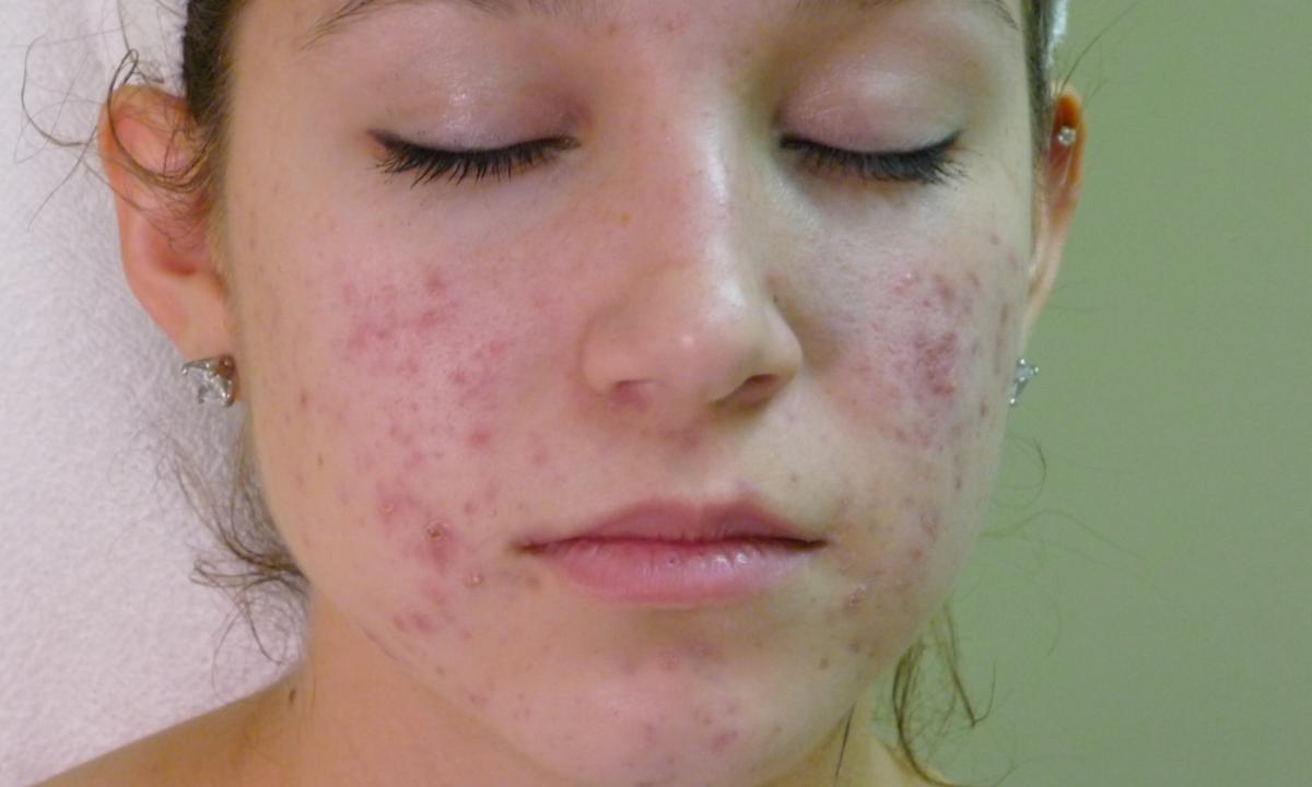 For what reasons the acne rash develops