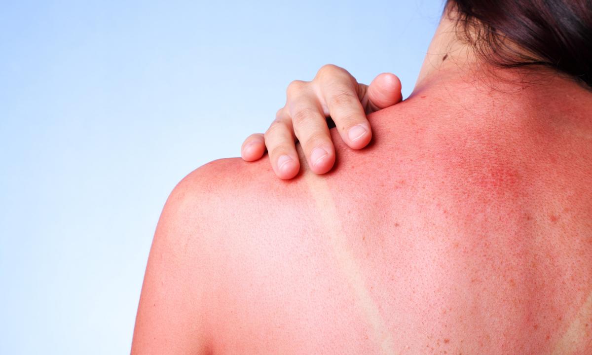 How to treat burns for the sun