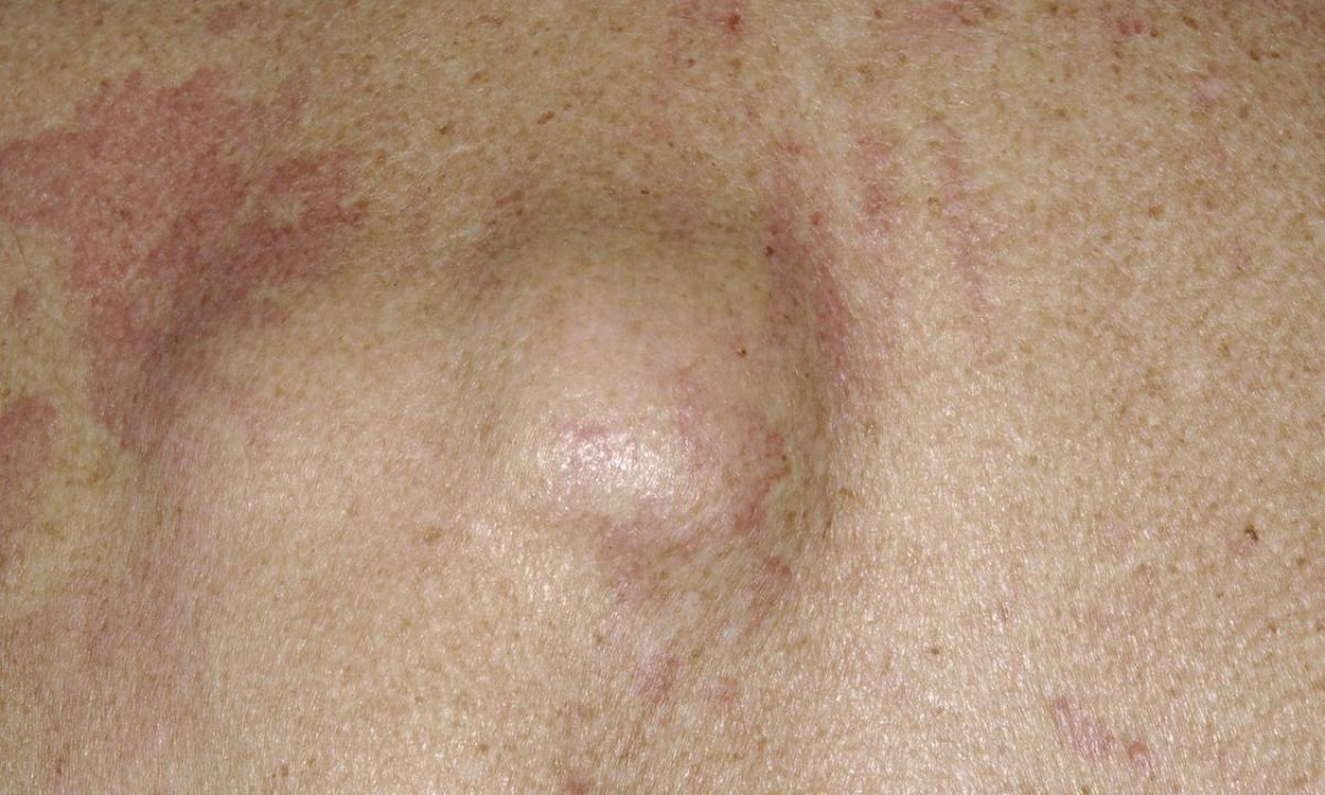Why on skin fatty tumors appear