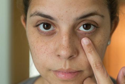 What to do if dark circles under eyes