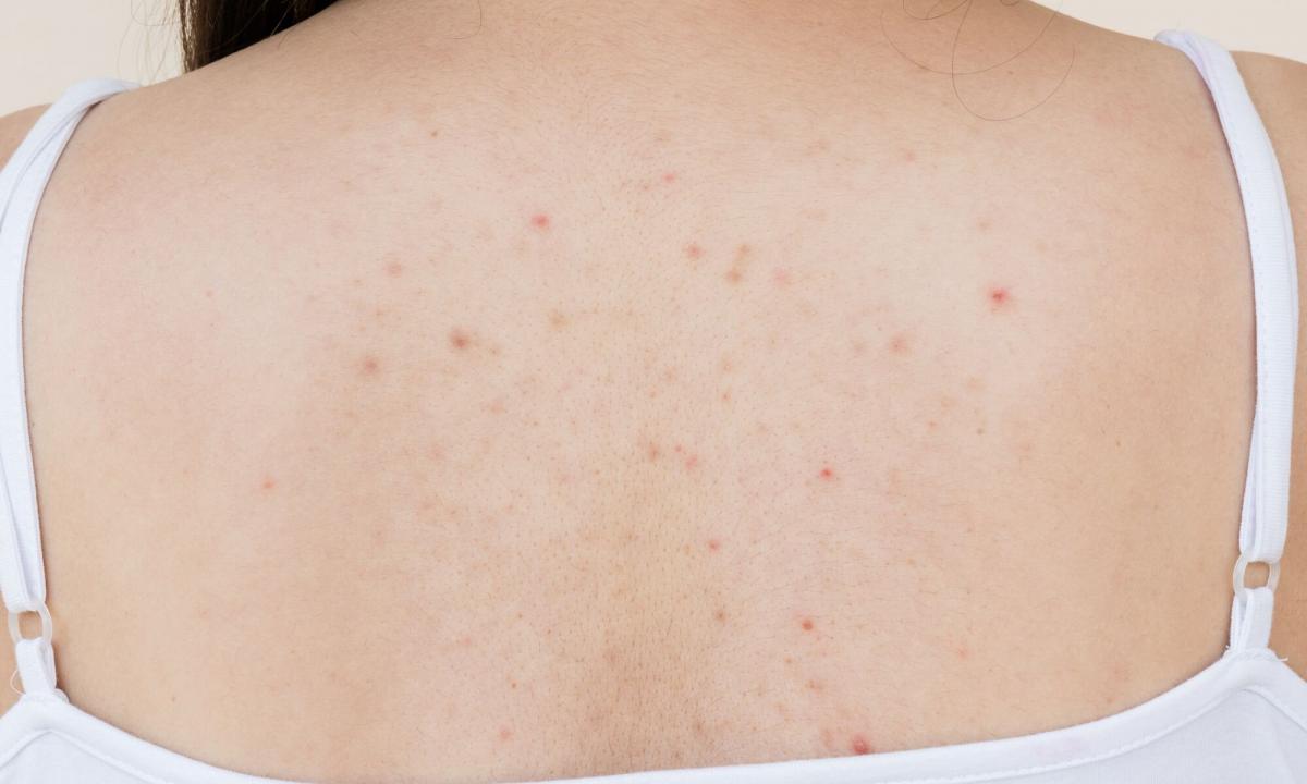 How to get rid of acne rash on spin