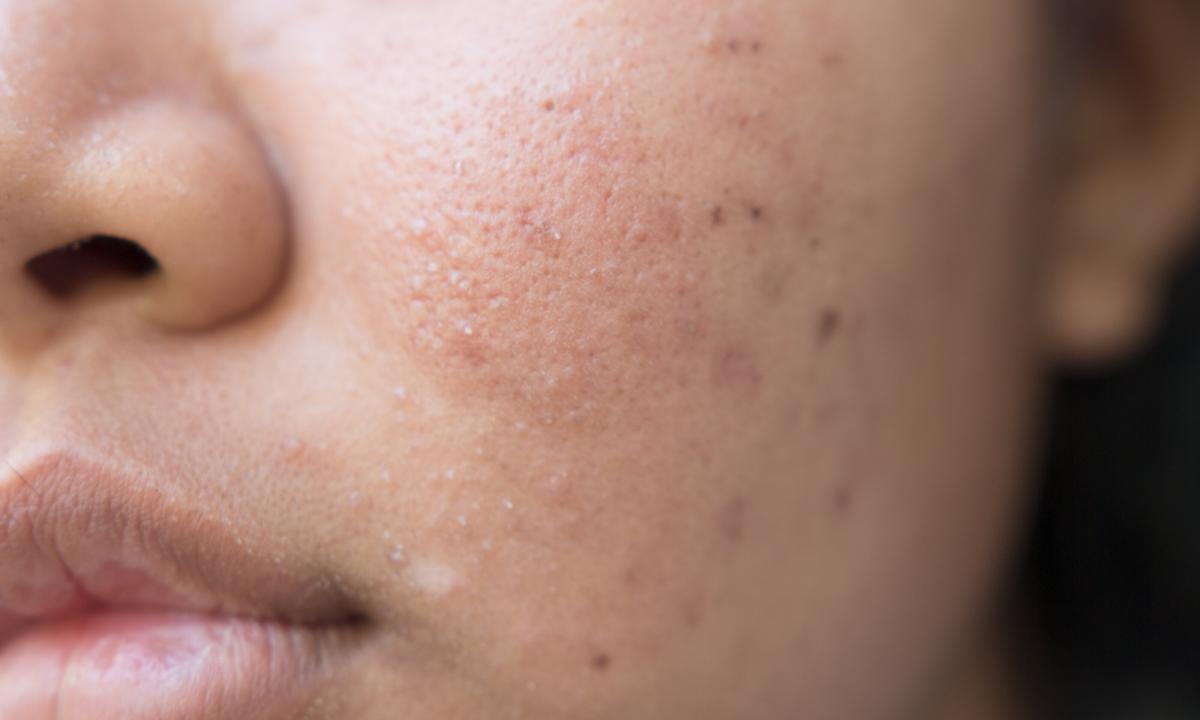How to purify leather from post-acne? We delete spots from pimples in house conditions