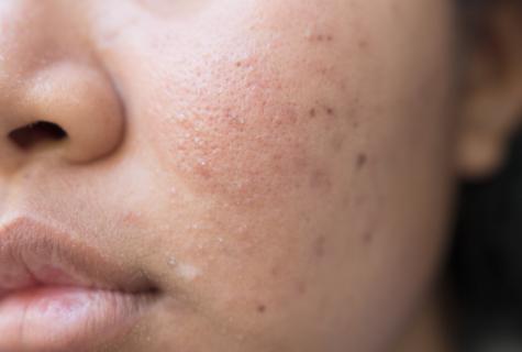 How to purify leather from post-acne? We delete spots from pimples in house conditions
