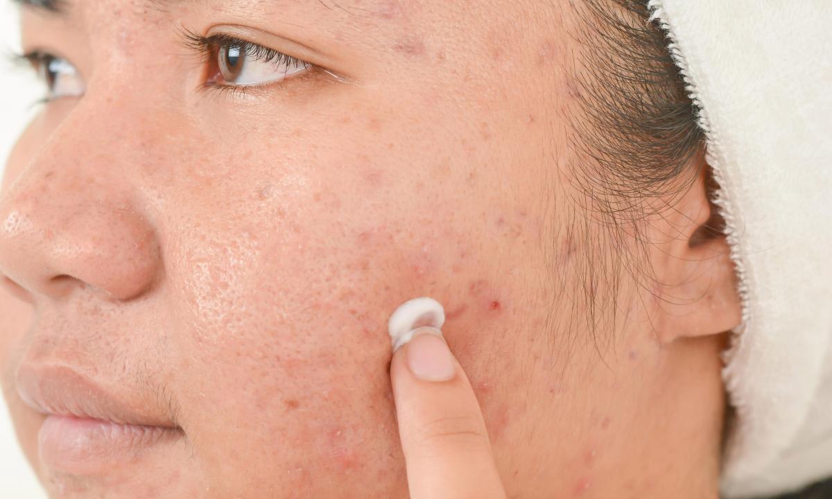How quickly to get rid of spots after pimples