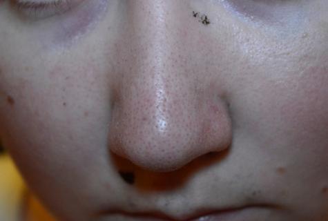 The reasons of black dots on nose