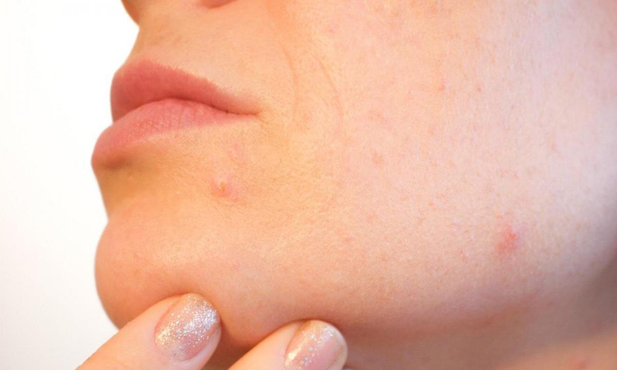 How to remove pimple