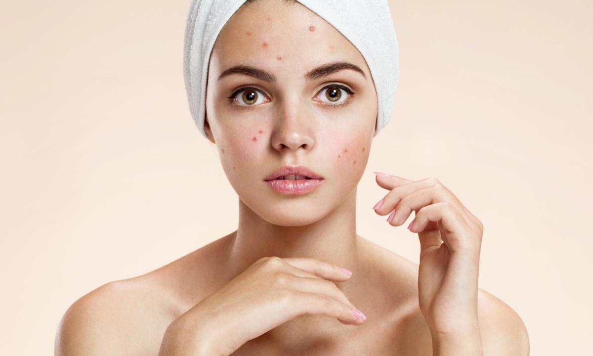 How to reduce redness of pimple