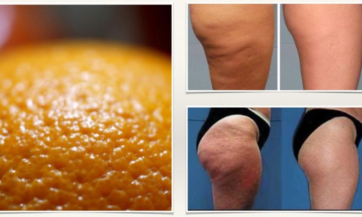 How to get rid of cellulitis at all its stages