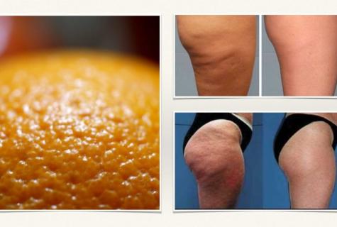 How to get rid of cellulitis at all its stages