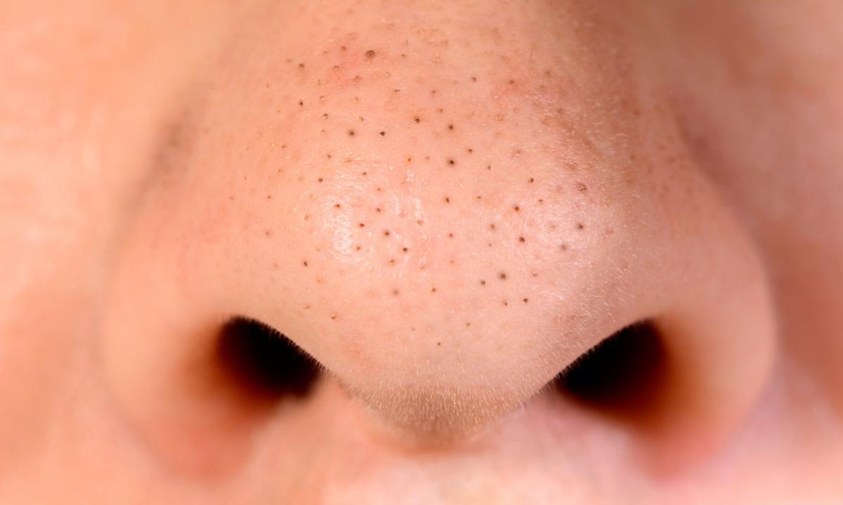 How to get rid of enlarged pores and black dots on face