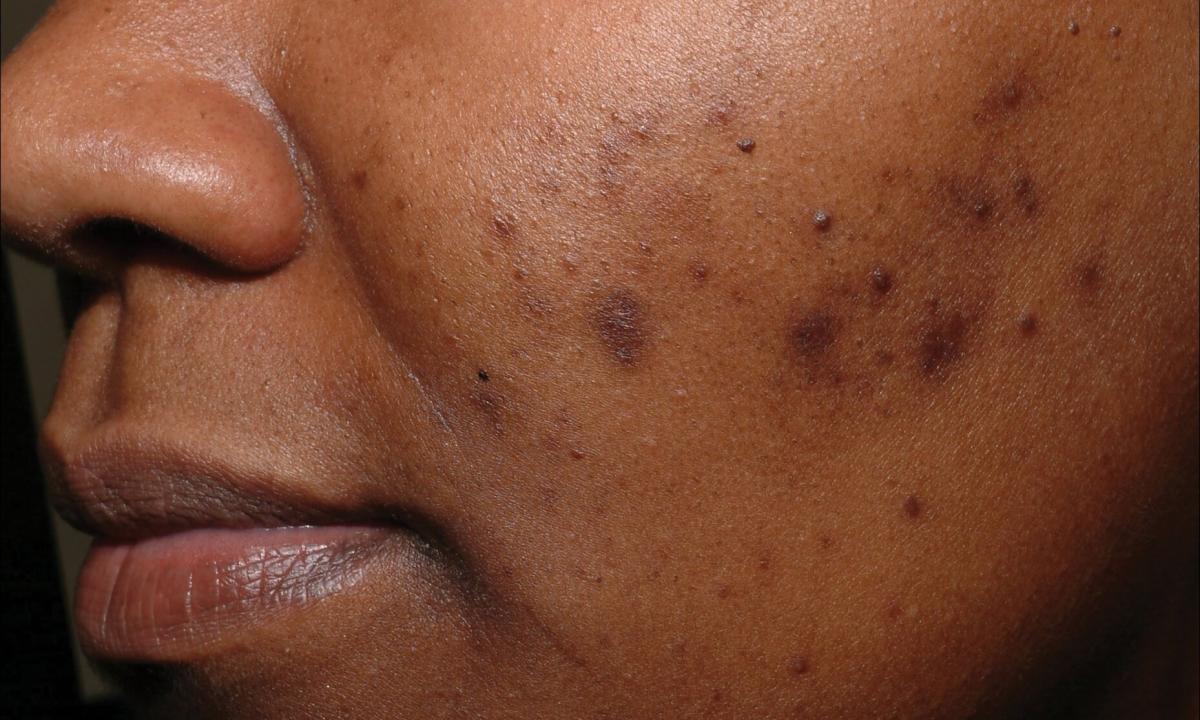 As without trace to get rid of pigmental spots on face