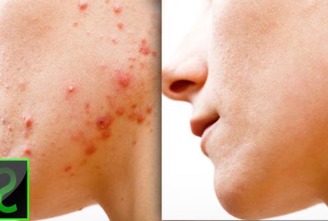 How to treat hems for pimples