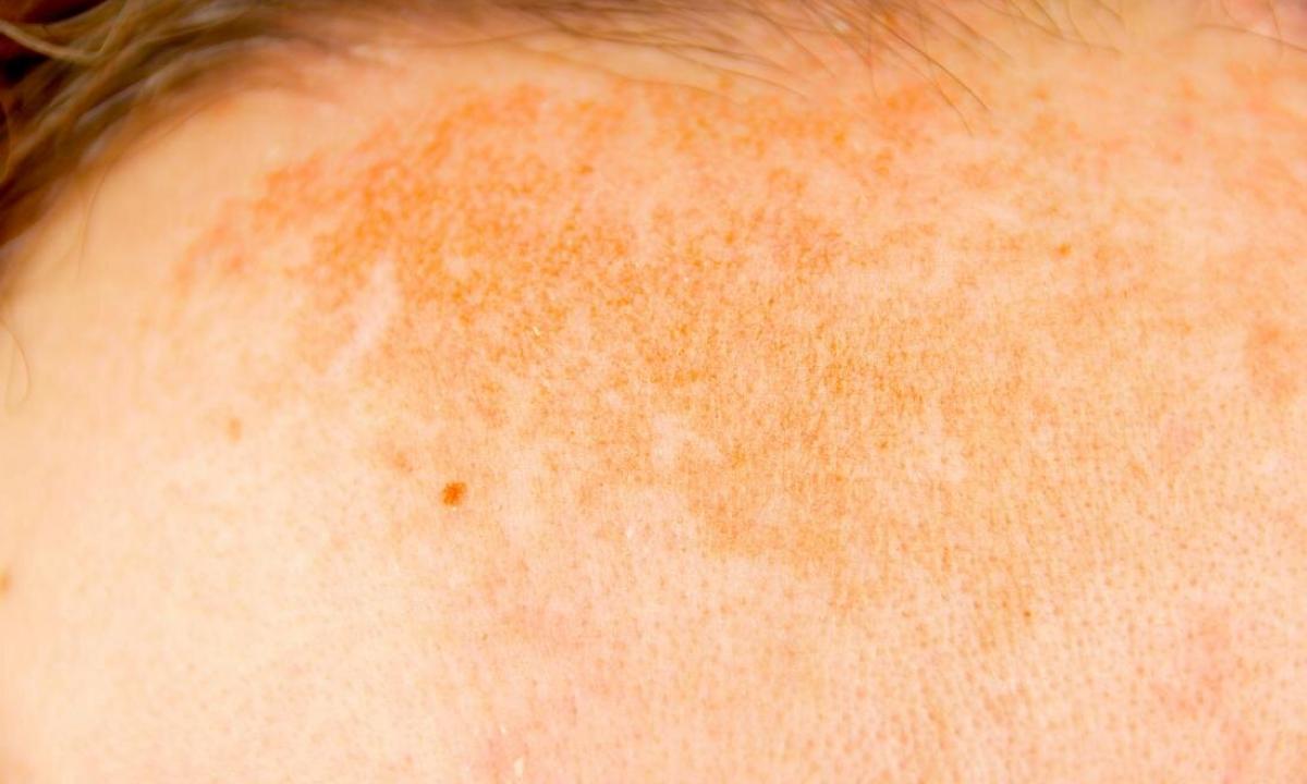 How to get rid of pigmental spots on face in house conditions