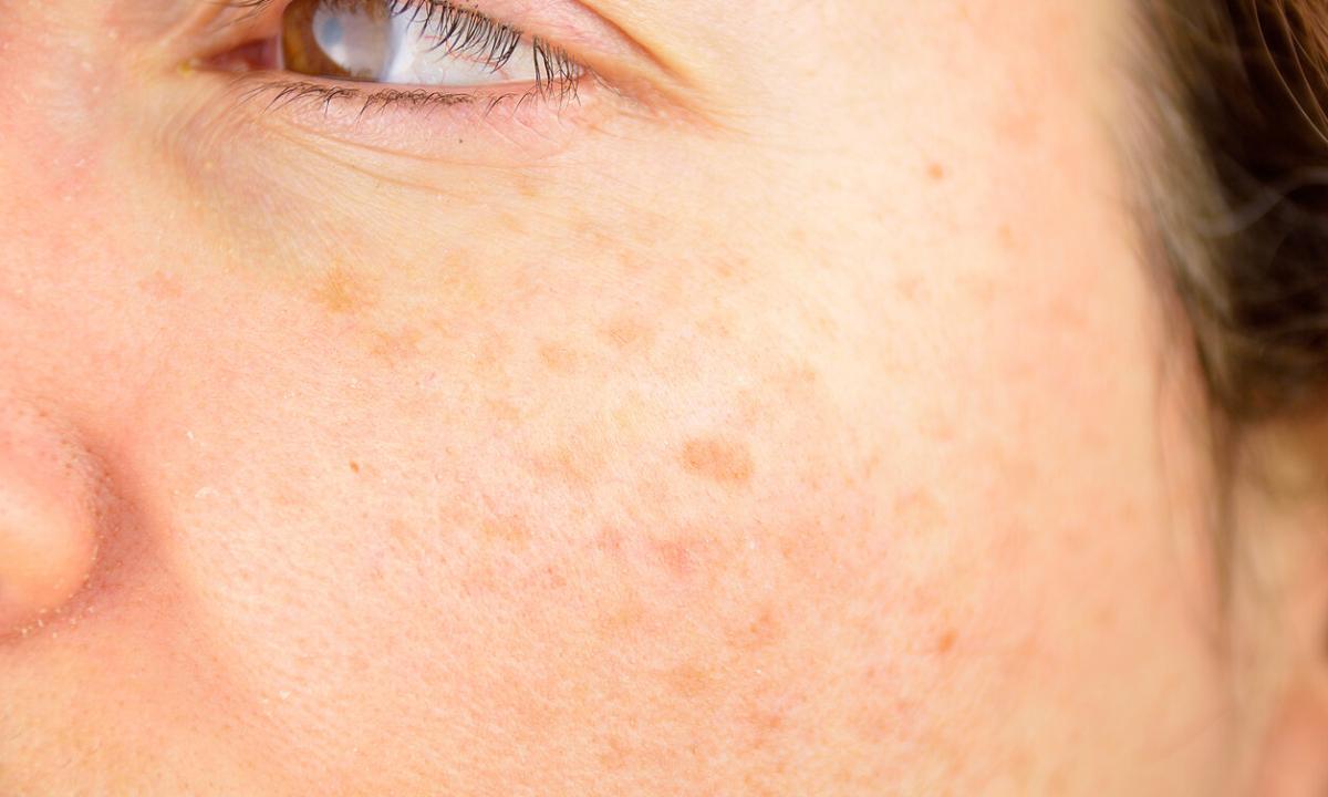 How to get rid of pigmental age spots