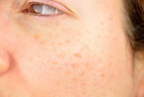 How to get rid of pigmental age spots