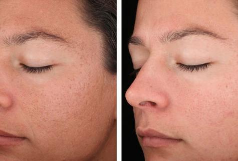 Mechanical face peel from black dots