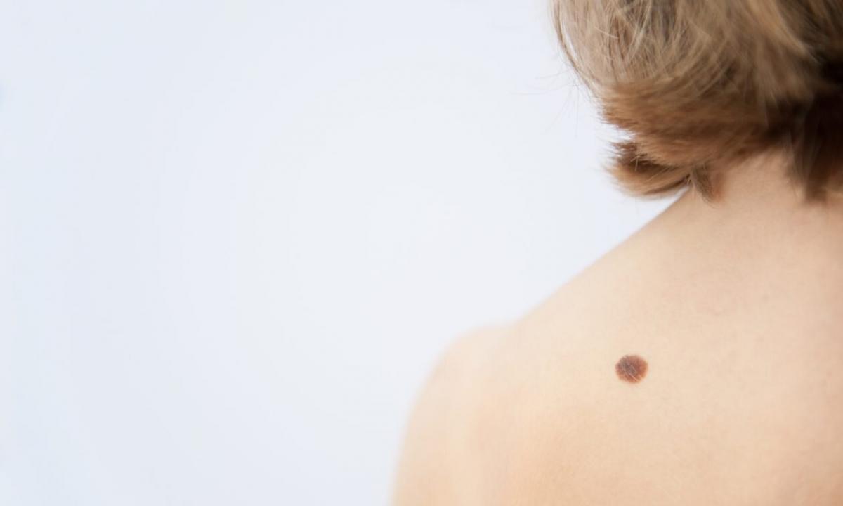 As it is safe to remove birthmark