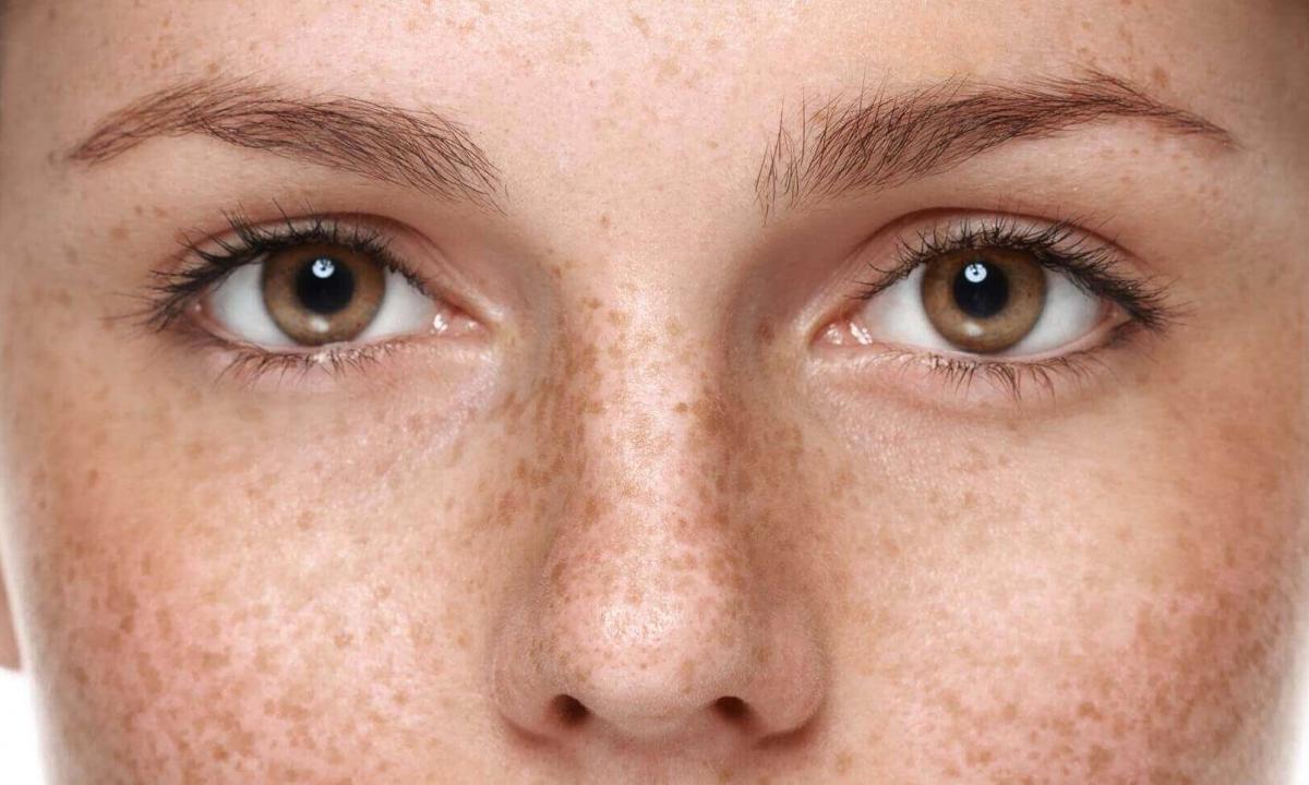 How quickly to get rid of pigmentation